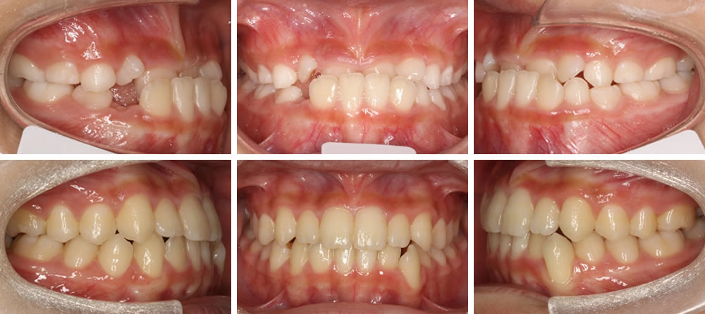 子どもの受け口の矯正治療例