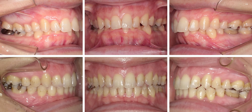 過蓋咬合の矯正治療例