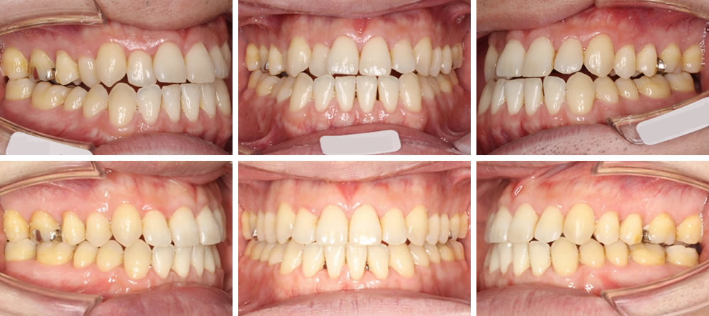 部分矯正の矯正治療例