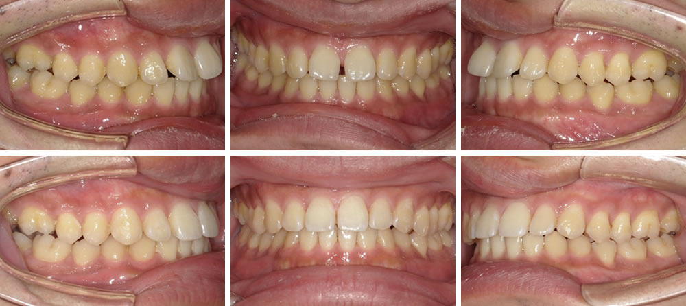 部分矯正の矯正治療例
