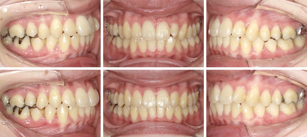 部分矯正の矯正治療例