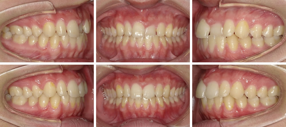 部分矯正の矯正治療例