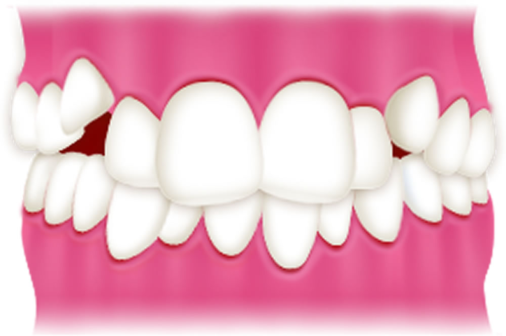 子供の叢生・八重歯の治療