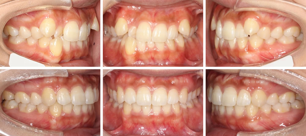 八重歯・叢生(デコボコの歯列)の矯正治療例